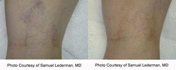 laser vein removal